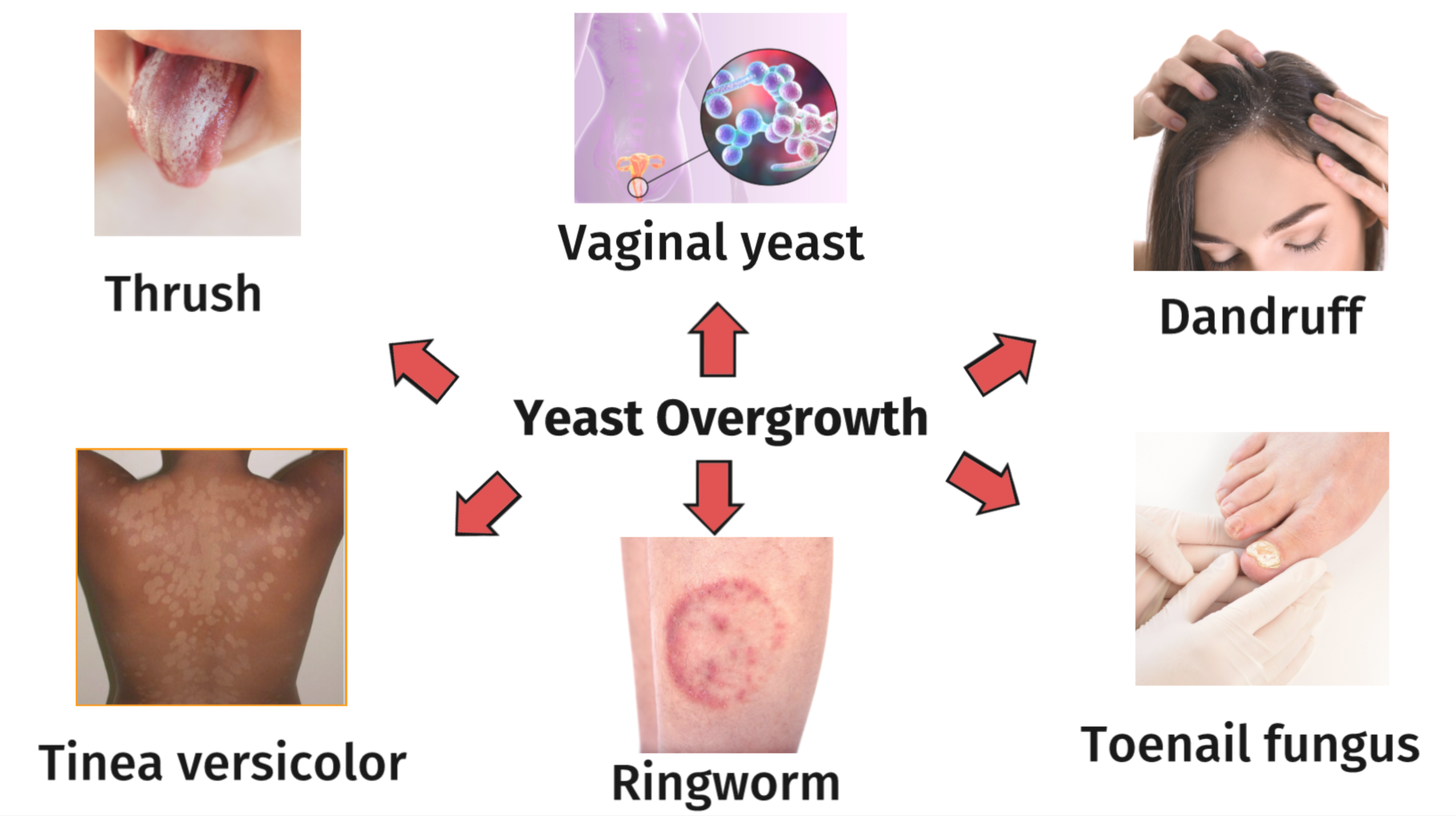 Fungal and Yeast Infections Like Candida